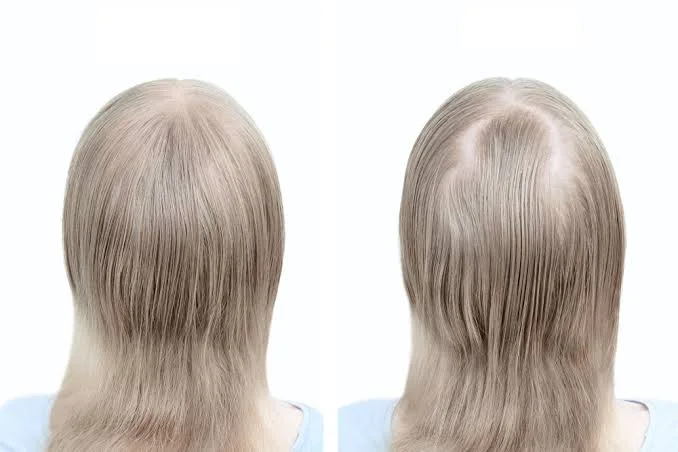 مراكز زراعة الشعر للنساء في دبي