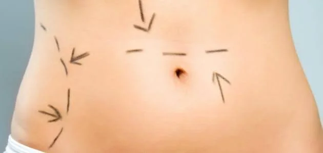 شفط الدهون بدون جراحة في دبي