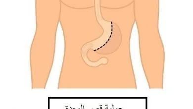 تكميم المعدة في دبي
