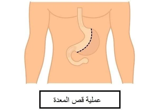 تكميم المعدة في دبي