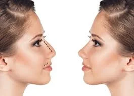 تجميل الأنف في دبي